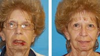 Reconstruction Before & After Gallery - Patient 1790368 - Image 1