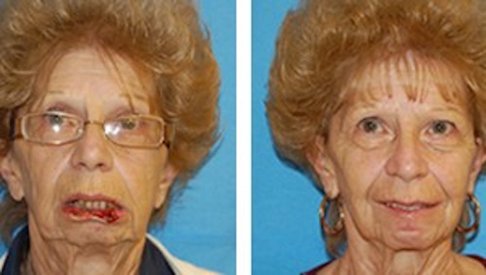 Reconstruction Before & After Gallery - Patient 1790368 - Image 1