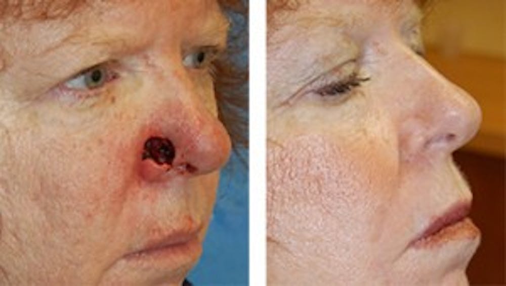 Reconstruction Before & After Gallery - Patient 1790369 - Image 1