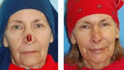 Reconstruction Before & After Gallery - Patient 1790370 - Image 1