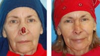 Reconstruction Before & After Gallery - Patient 1790370 - Image 1