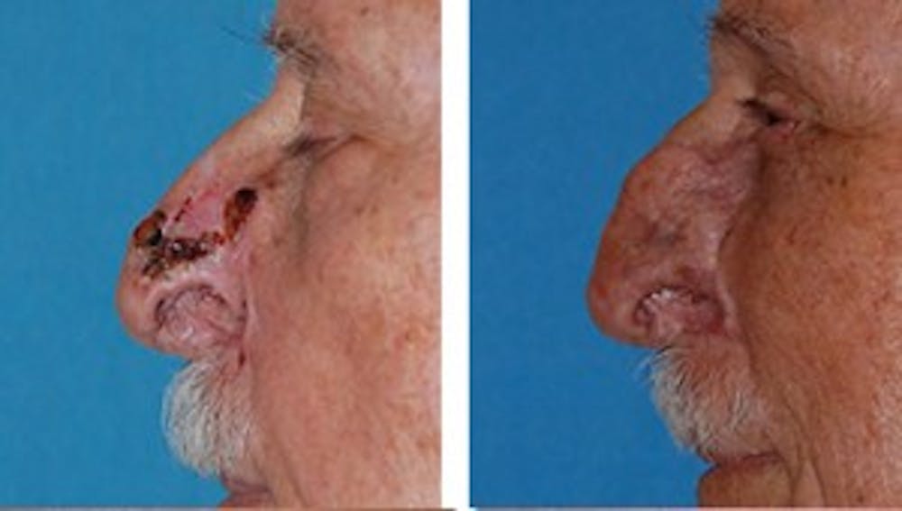 Reconstruction Before & After Gallery - Patient 1790371 - Image 1