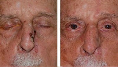 Reconstruction Before & After Gallery - Patient 1790371 - Image 2