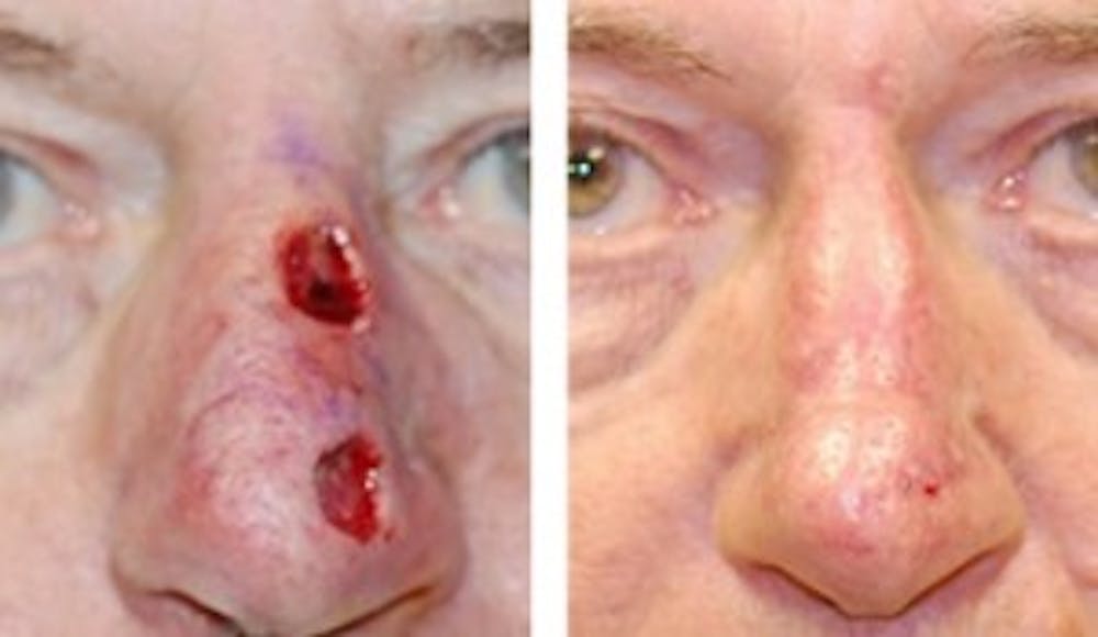 Reconstruction Before & After Gallery - Patient 1790374 - Image 1