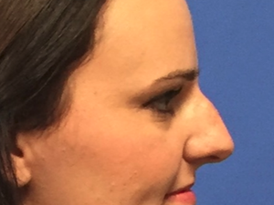 before and after non-surgical rhinoplasty