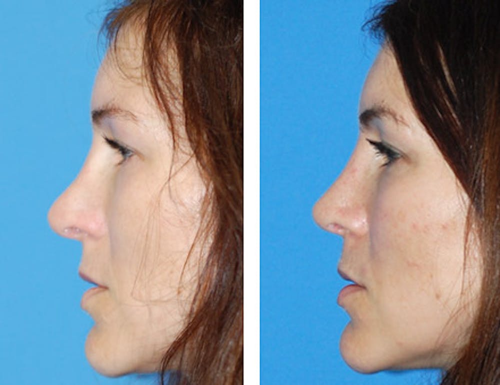 Revision Rhinoplasty Before & After Gallery - Patient 1909534 - Image 1