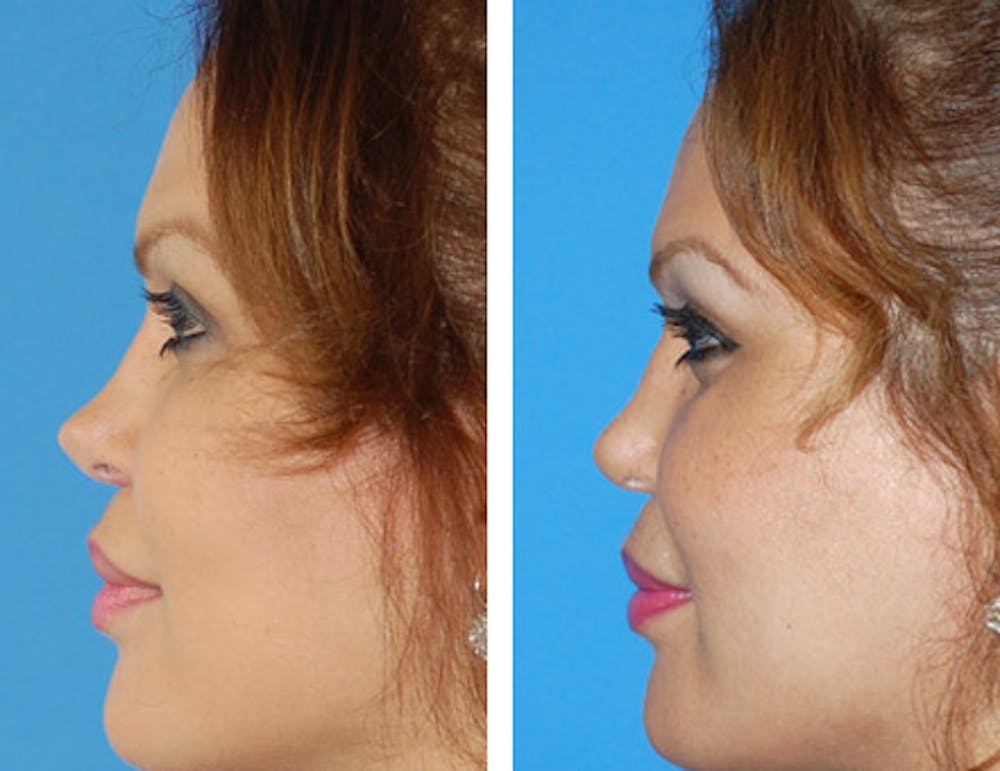 Revision Rhinoplasty Gallery - Patient 1909535 - Image 1