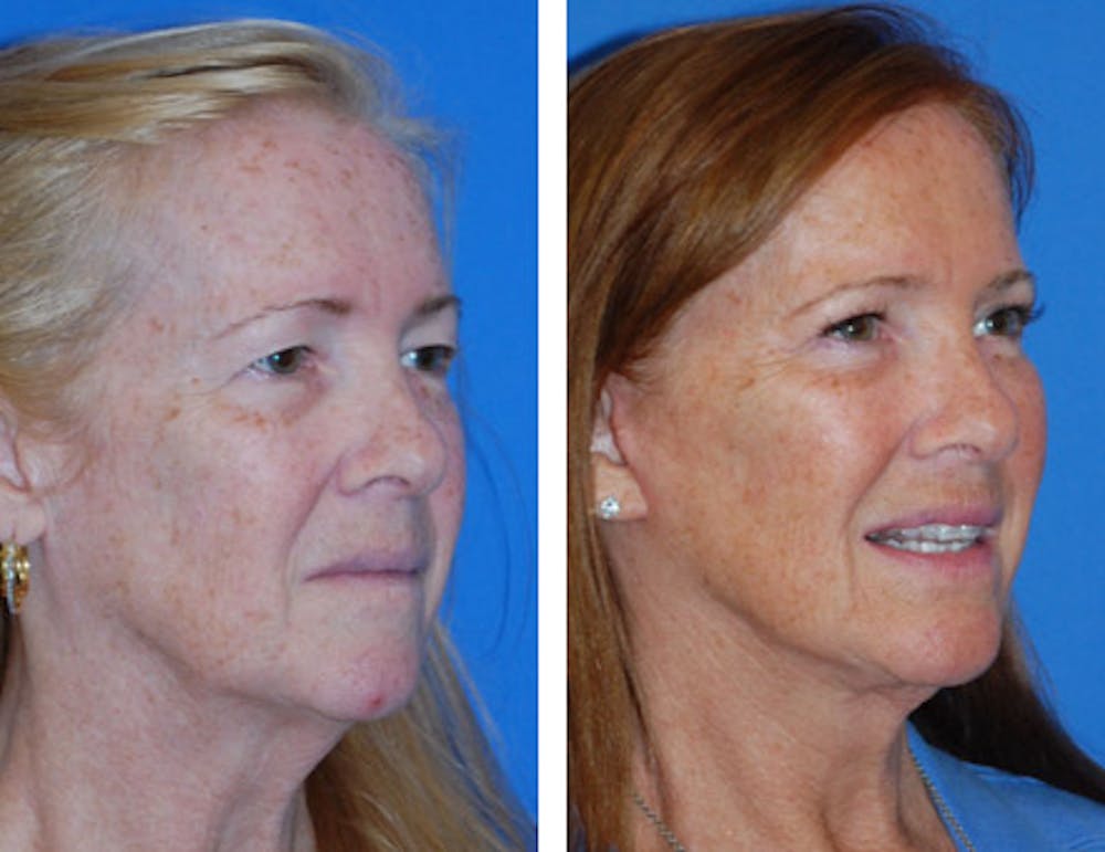 Facelift & Neck Lift Before & After Gallery - Patient 1909580 - Image 1