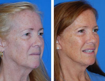 Facelift & Neck Lift Before & After Gallery - Patient 1909580 - Image 1
