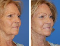 Facelift & Neck Lift Before & After Gallery - Patient 1909581 - Image 1