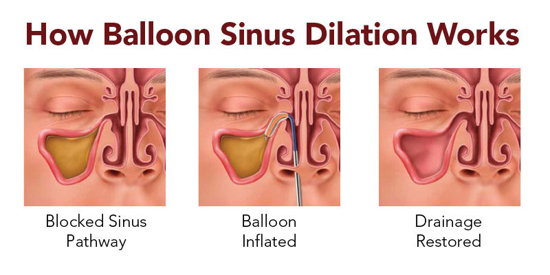 picture of a balloon sinuplasty