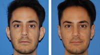 Ear Surgery/Otoplasty Before & After Gallery - Patient 1972853 - Image 1