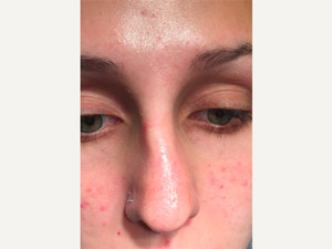 before non-surgical rhinoplasty
