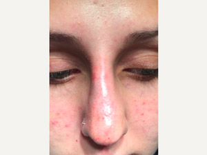 after non-surgical rhinoplasty