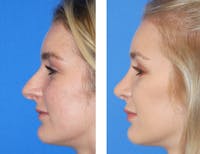 Rhinoplasty Before & After Gallery - Patient 2137543 - Image 1