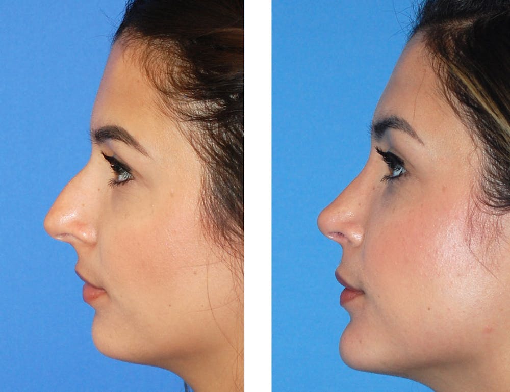 Rhinoplasty Before & After Gallery - Patient 2137544 - Image 1