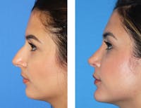 Rhinoplasty Before & After Gallery - Patient 2137544 - Image 1