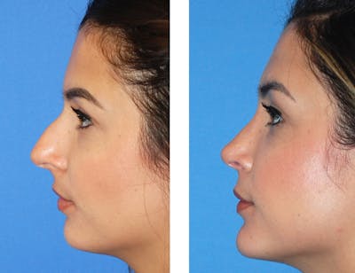 Rhinoplasty Before & After Gallery - Patient 2137544 - Image 1