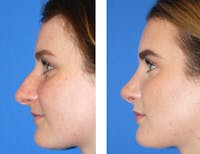 Rhinoplasty Before & After Gallery - Patient 2137545 - Image 1