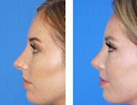Rhinoplasty Before & After Gallery - Patient 2137546 - Image 1