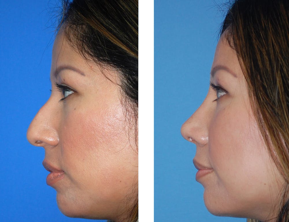 Rhinoplasty Before & After Gallery - Patient 2137547 - Image 1