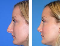 Rhinoplasty Before & After Gallery - Patient 2137548 - Image 1