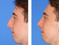 Rhinoplasty Before & After Gallery - Patient 2137549 - Image 1