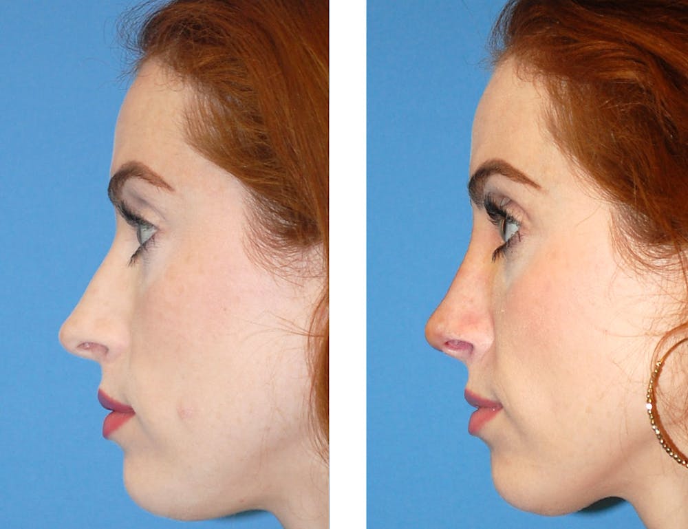 Rhinoplasty Before & After Gallery - Patient 2137550 - Image 1