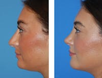 Rhinoplasty Before & After Gallery - Patient 5899270 - Image 1