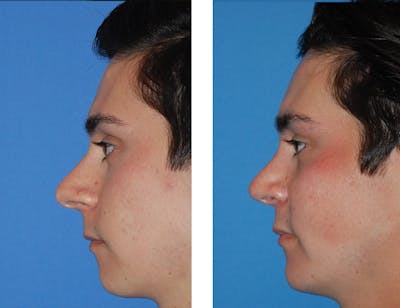 Rhinoplasty Before & After Gallery - Patient 5899273 - Image 1