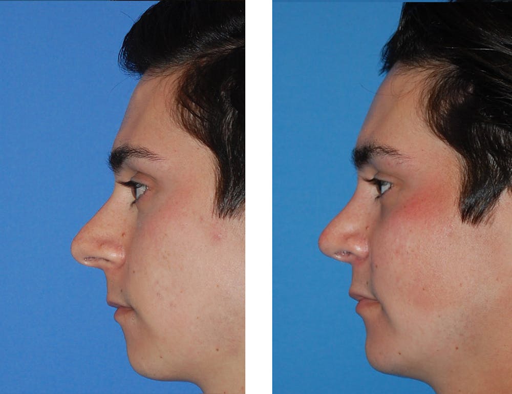 Rhinoplasty Before & After Gallery - Patient 5899273 - Image 1