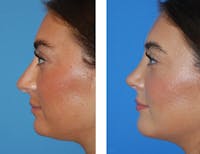 Chin Augmentation Before & After Gallery - Patient 5899277 - Image 1
