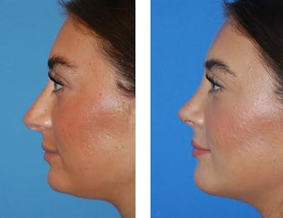 Chin Augmentation Before & After Gallery - Patient 5899277 - Image 1