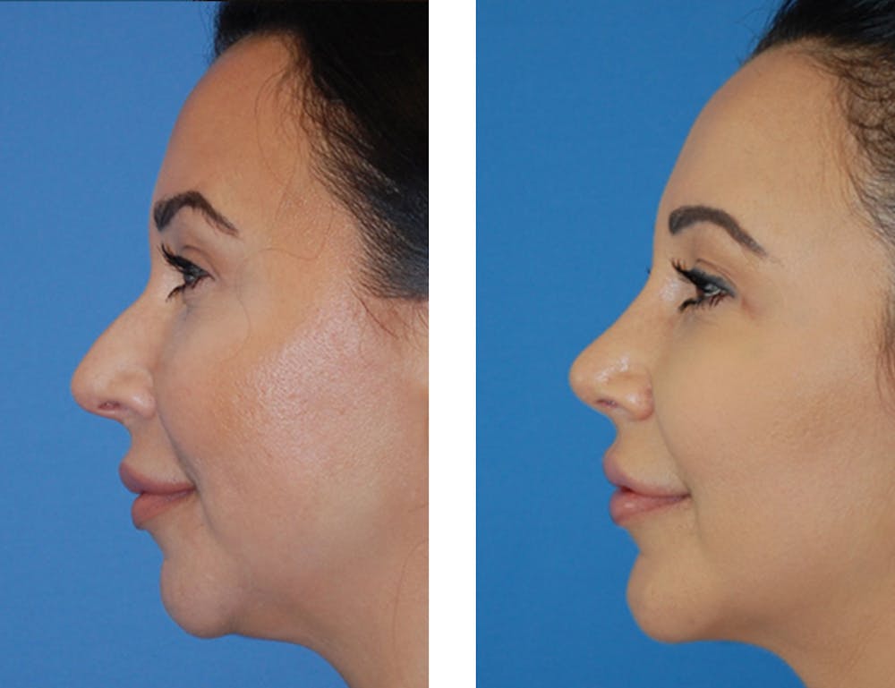 Chin Augmentation Before & After Gallery - Patient 5899279 - Image 1