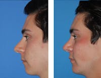 Chin Augmentation Before & After Gallery - Patient 5899280 - Image 1