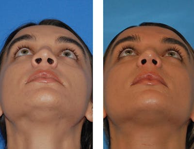Nostril Reduction Before & After Gallery - Patient 5899522 - Image 1