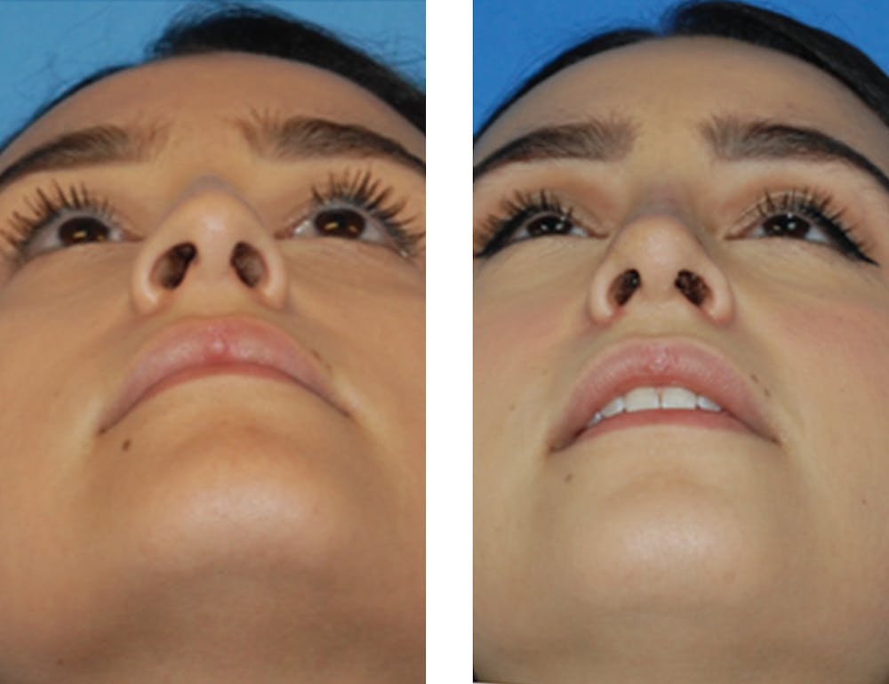 Nostril Reduction Before & After Gallery - Patient 5899523 - Image 1