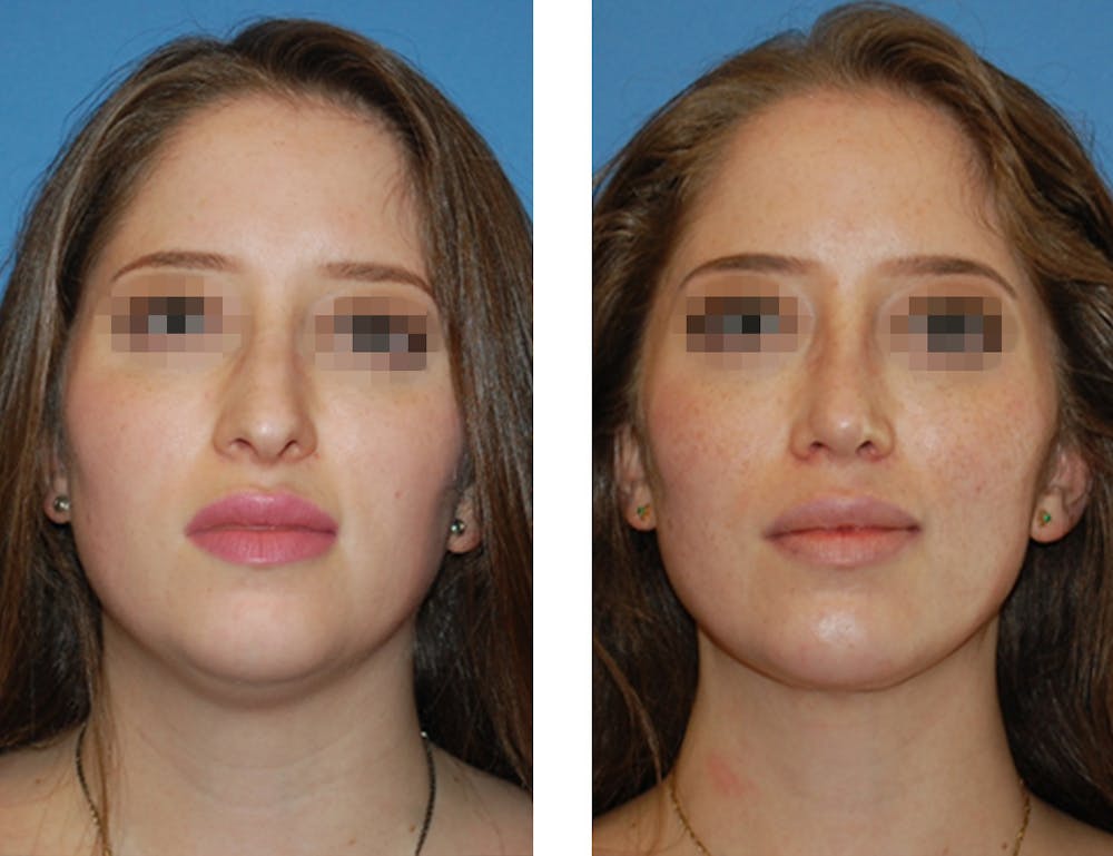Nostril Reduction Before & After Gallery - Patient 5899524 - Image 1