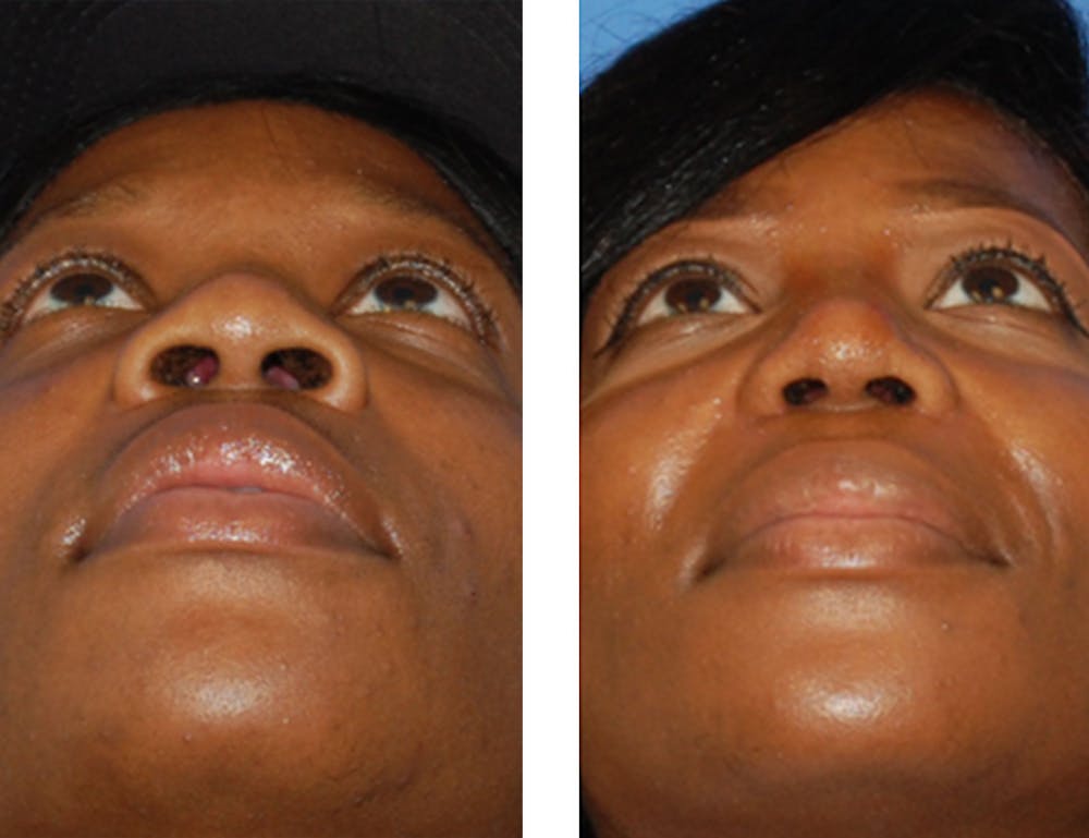 Nostril Reduction Before & After Gallery - Patient 7316510 - Image 1