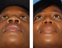 Nostril Reduction Before & After Gallery - Patient 7316510 - Image 1