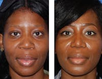 Nostril Reduction Before & After Gallery - Patient 8341489 - Image 1