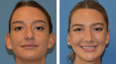 Ear Surgery/Otoplasty Before & After Gallery - Patient 26207554 - Image 1
