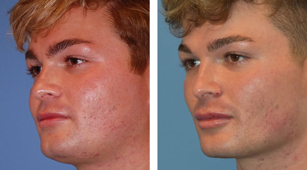 Buccal Fat Pad Removal Before & After Gallery - Patient 26207656 - Image 2