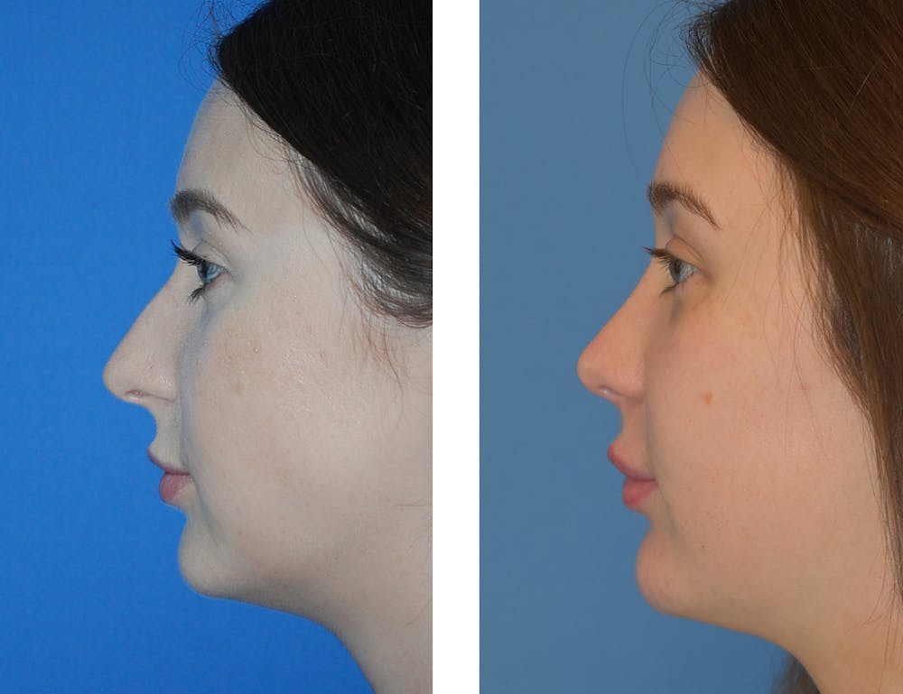Rhinoplasty Before & After Gallery - Patient 49633079 - Image 1
