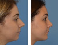 Rhinoplasty Before & After Gallery - Patient 49633078 - Image 1