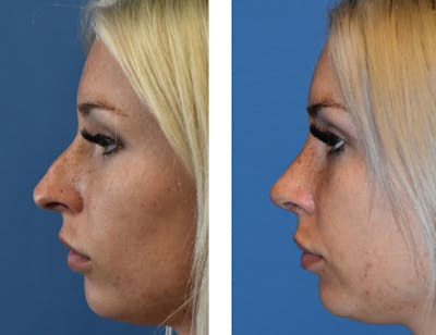 Rhinoplasty Before & After Gallery - Patient 49633077 - Image 1