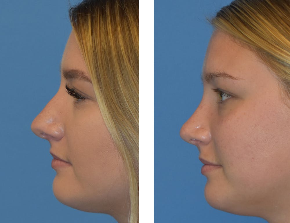 Rhinoplasty Before & After Gallery - Patient 49633076 - Image 1