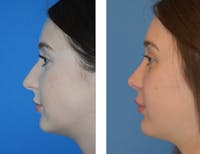 Chin Augmentation Before & After Gallery - Patient 49633230 - Image 1