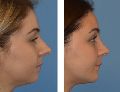 Chin Augmentation Before & After Gallery - Patient 49633229 - Image 1