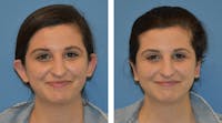 Ear Surgery/Otoplasty Before & After Gallery - Patient 49633410 - Image 1